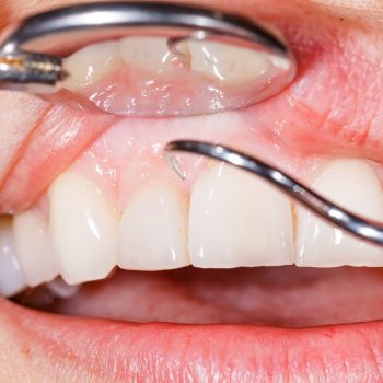 Signs and symptoms of gum disease