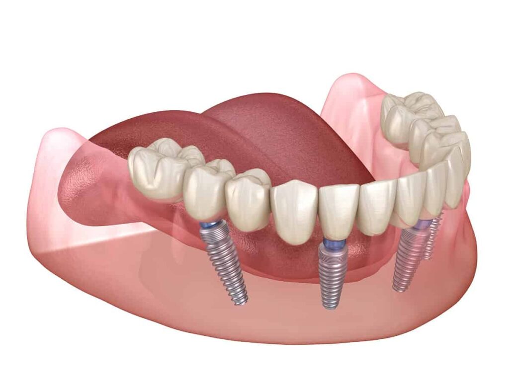 Dentures in Hellam & York, PA