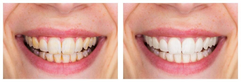 Tooth whitening in Hellam & York, PA