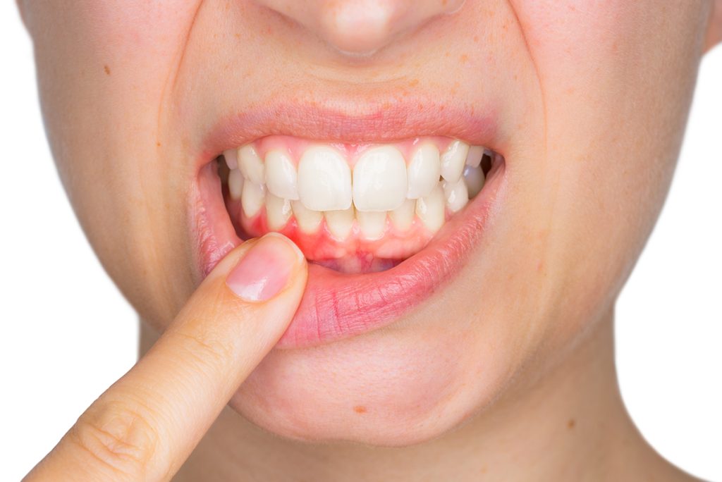 Gum disease treatment York dentist
