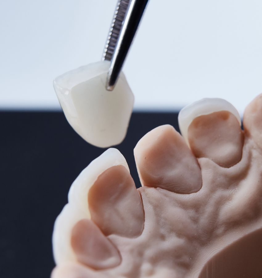 Dental Veneers in Hallam and East York, PA