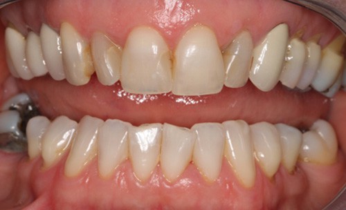 c2-broadening-smile-before